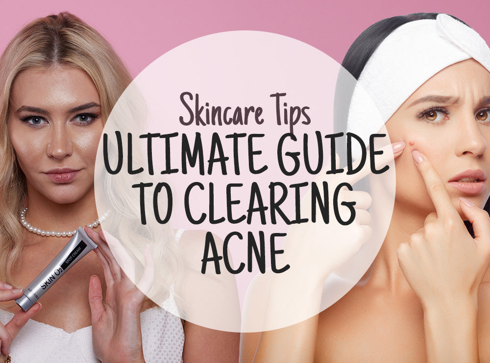 The Ultimate Guide to Clearing Acne