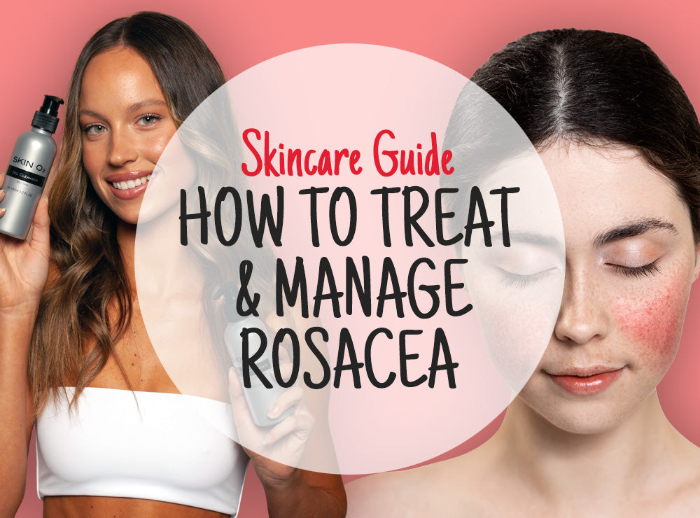 How To Treat & Manage Rosacea