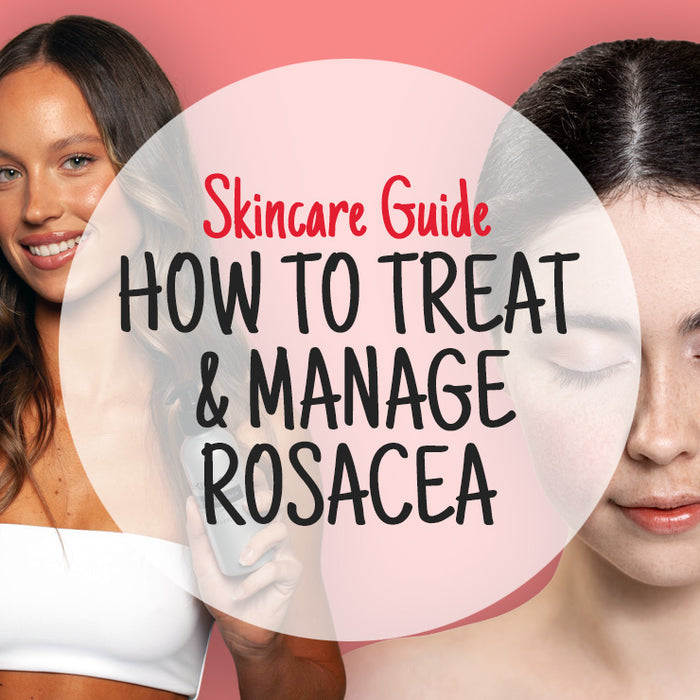 How To Treat & Manage Rosacea