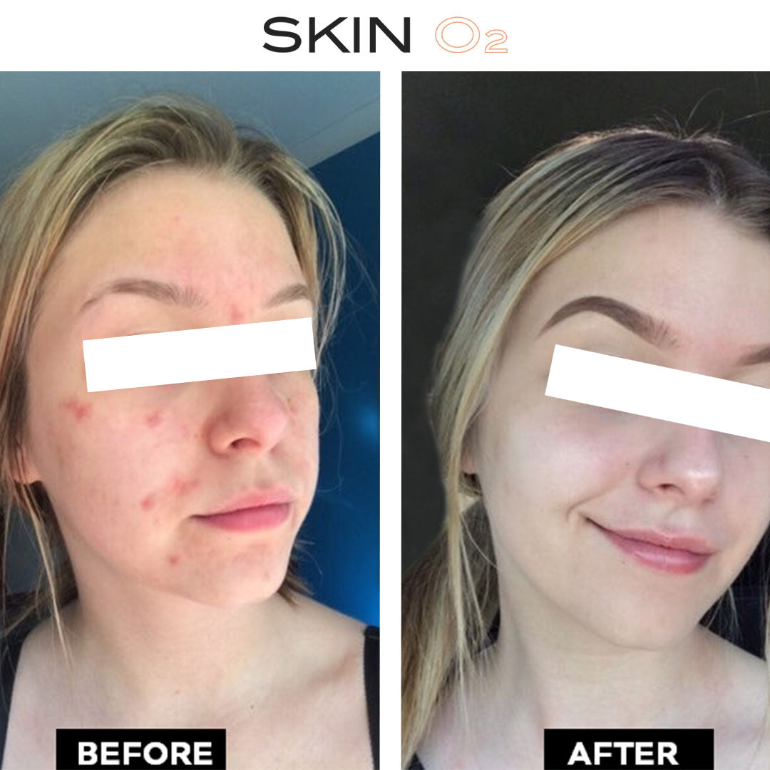 Salicylic Acid Serum