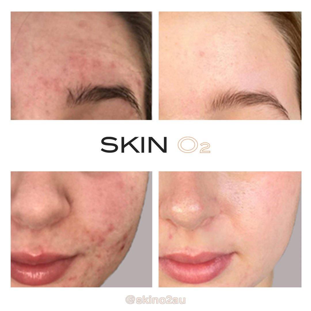 Clean Skin Pack - Skin O2
