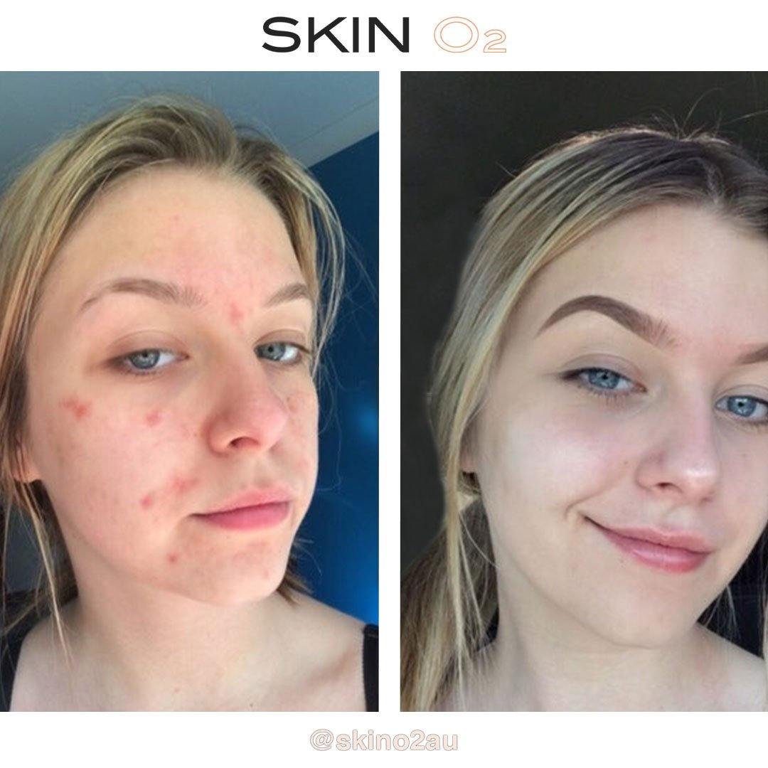 Spot Cream + GWP Concealer (Zit Kit) - Skin O2