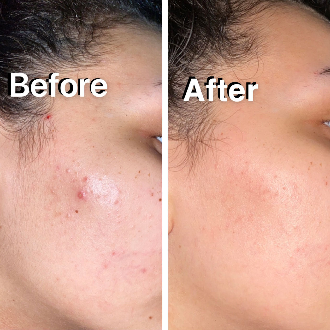 Anti-Acne Spot Cream + Free Concealer (Zit Kit)