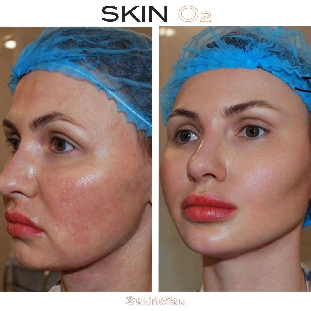 Skin Gym - Face & Body Toner+ Derma Fill - Skin O2